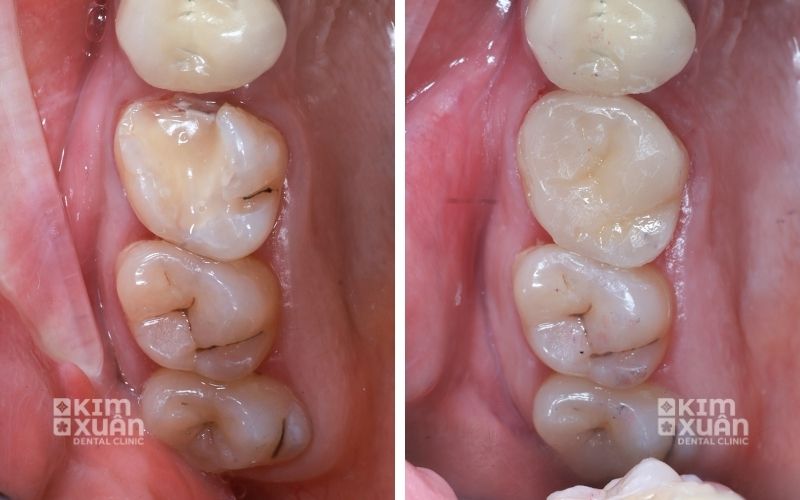 Ảnh Trước Và Sau Khi Trám Răng Inlay/Onlay