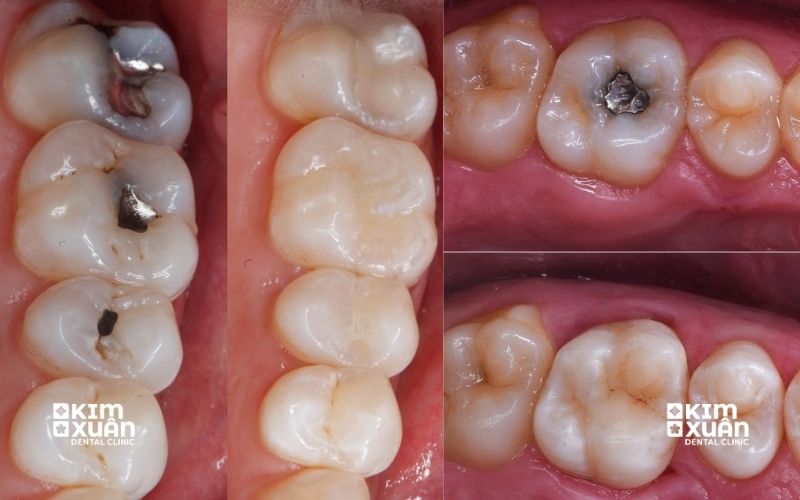 Ảnh Trước Và Sau Khi Trám Răng Lấy Tủy