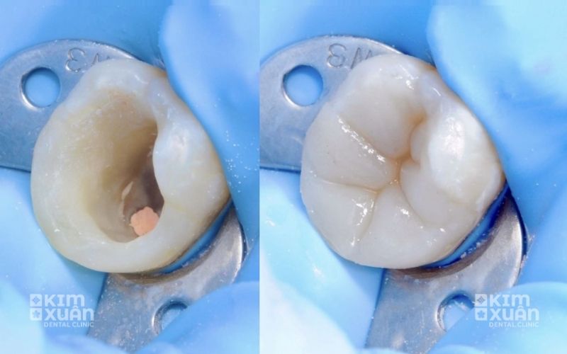 Ảnh Trước Và Sau Khi Trám Răng Sâu Lỗ To