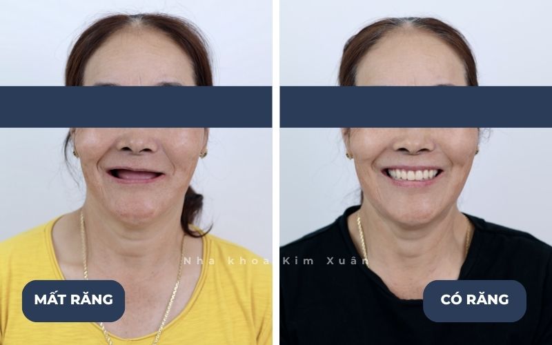 Ảnh Trước Và Sau Khi Trồng Răng Cho Người Già Tại Nha Khoa Kim Xuân