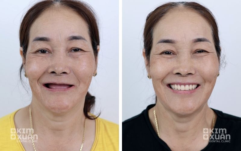 Ảnh Trước Và Sau Khi Trồng Răng Implant All On 4 Tại Nha Khoa Kim Xuân