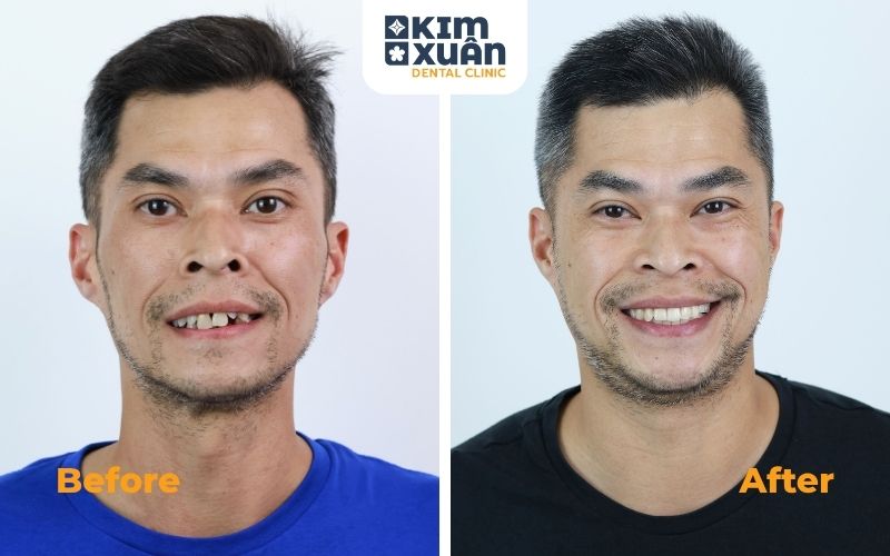 Trồng Răng implant Tại Nha Khoa Kim Xuân