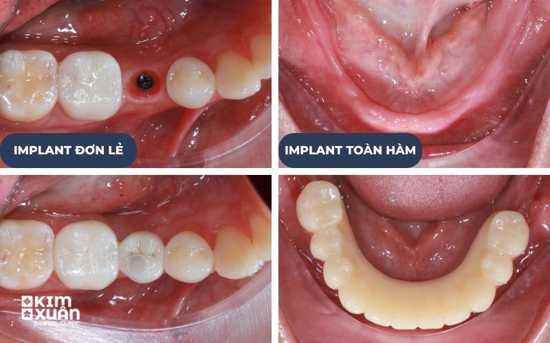 Ảnh Trước Và Sau Khi Trồng Răng Implant