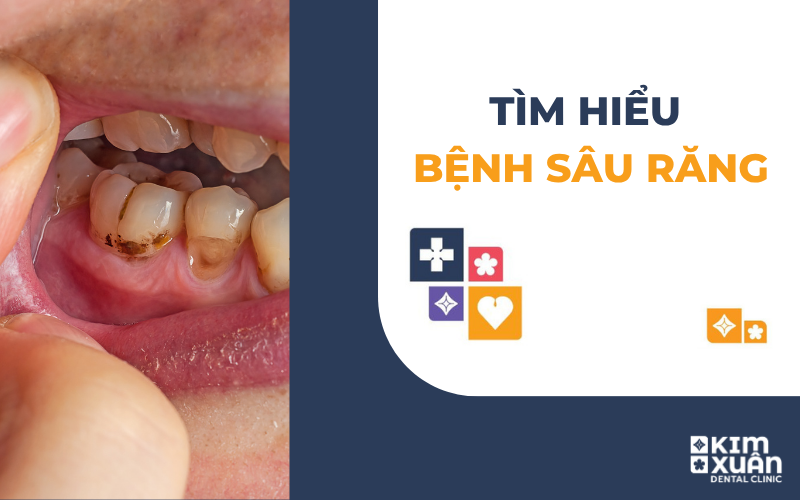 Bệnh Sâu Răng Là Gì?