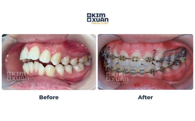 Bị Hô Hàm Trên Có Chỉnh Nha Niềng Răng Được Không