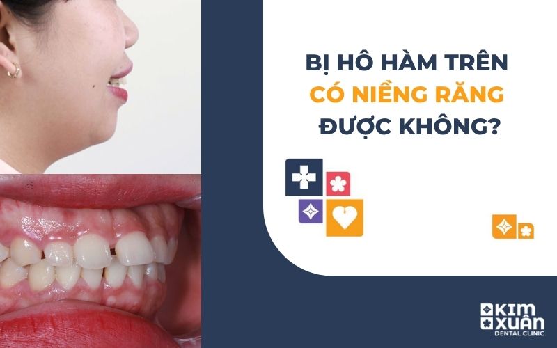 Bị Hô Hàm Trên Có Niềng Răng Chỉnh Nha Được Không