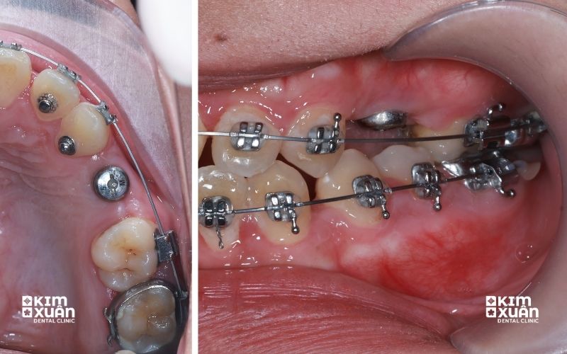 Bị Mất Răng Có Niềng Răng Được Không