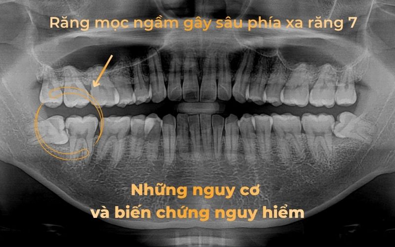 Biến chứng nguy hiểm khi răng mọc kẹt