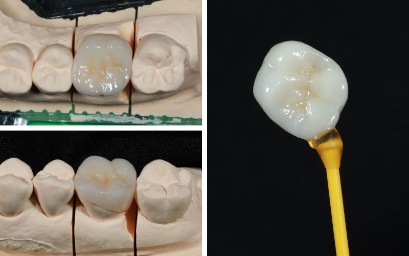 Bọc Răng Hàm Bị Sâu Giá Bao Nhiêu Tiền