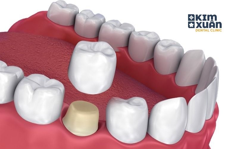 Bọc Răng Sứ