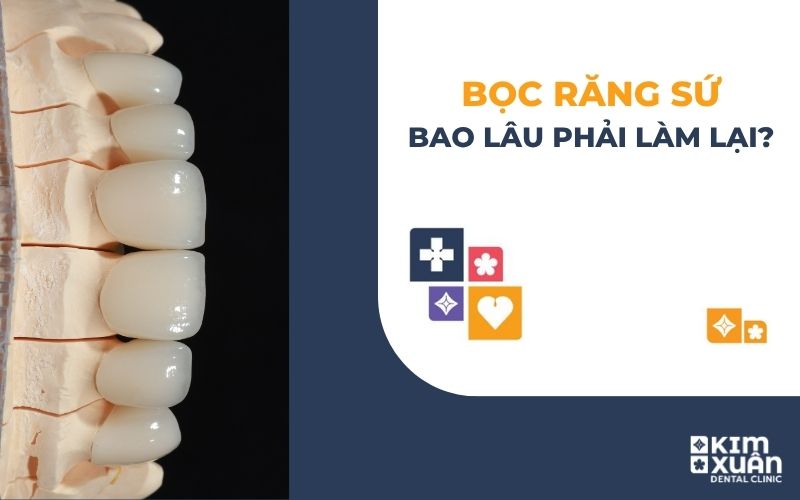 Bọc Răng Sứ Bao Lâu Phải làm Lại