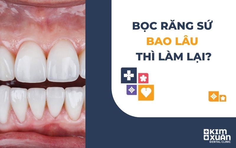 Bọc Răng Sứ Bao Lâu Thì Làm Lại