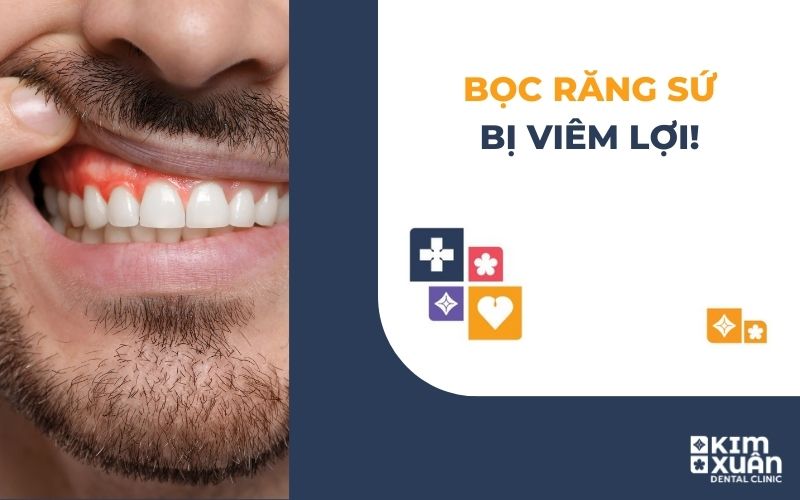Bọc Răng Sứ Bị Viêm Lợi