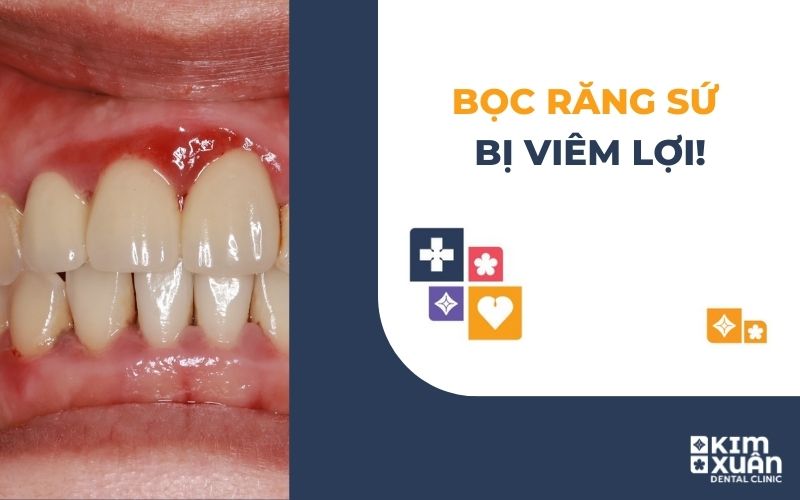 Bọc Răng Sứ Bị Viêm Lợi Do Đâu