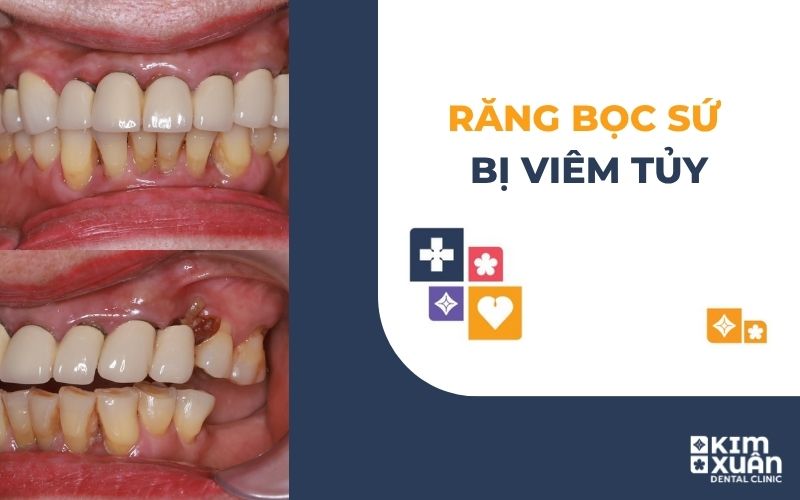 Bọc Răng Sứ Bị Viêm Tủy