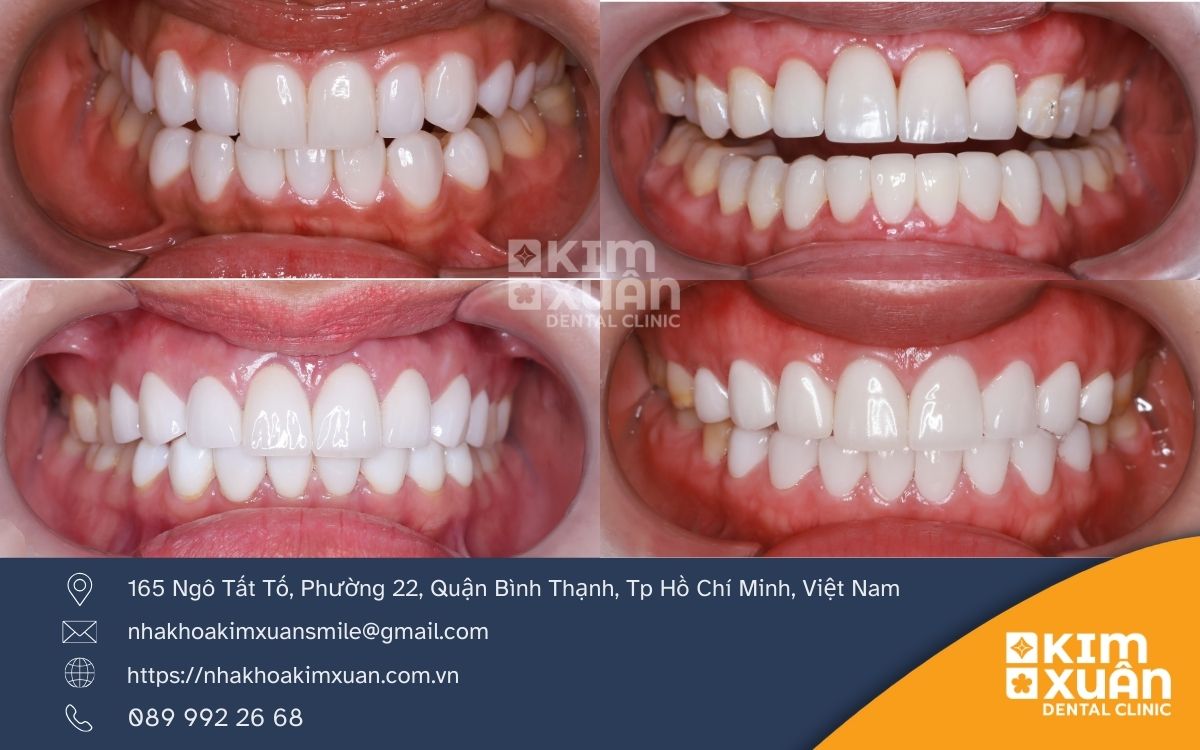 Bọc Răng Sứ Cercon HT Giá Bao Nhiêu