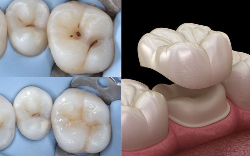 Bọc Răng Sứ Có Bị Sâu Không