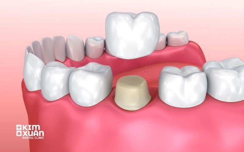 Bọc Răng Sứ Có Đau Không
