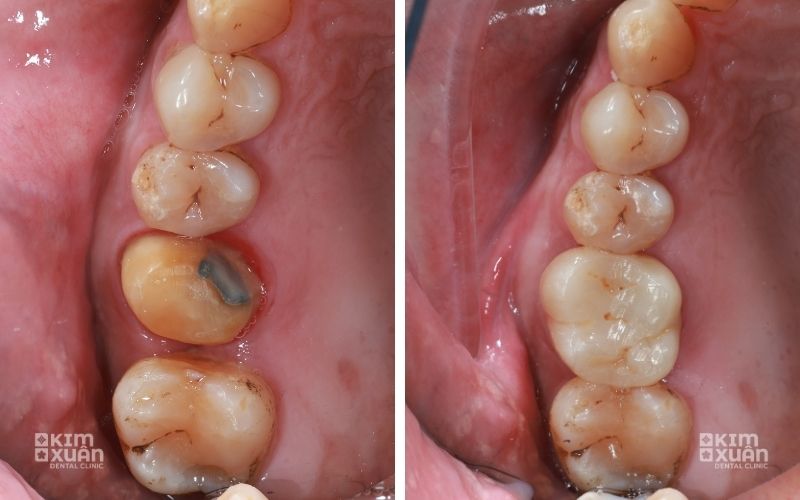 Hình ảnh thực tế trước và sau bọc răng sứ răng hàm, giúp giải đáp bọc răng sứ có đau không