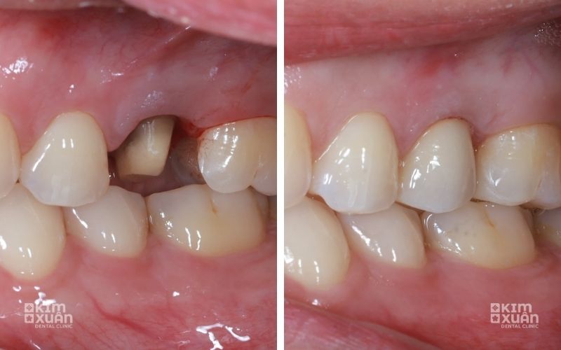 Hình ảnh thực tế trước và sau khi bọc răng sứ, giải đáp thắc mắc bọc răng sứ có đau không