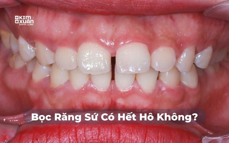 Bọc răng sứ có hết hô không