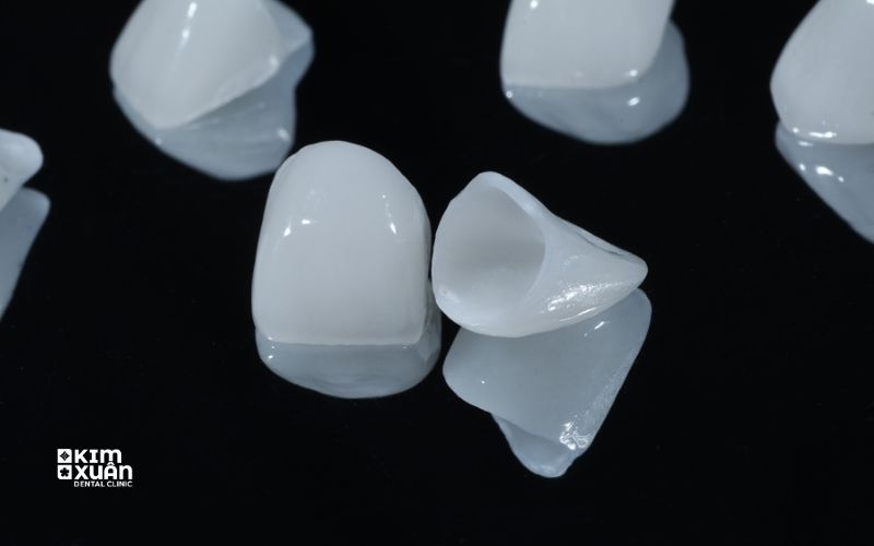 Bọc Răng Sứ Có Vĩnh Viễn Không