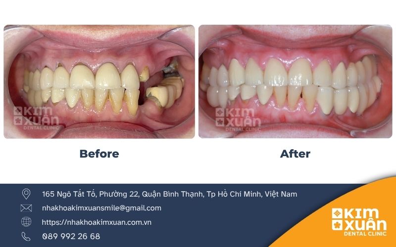 Bọc Răng Sứ Giá Bao Nhiêu Tại TP. HCM