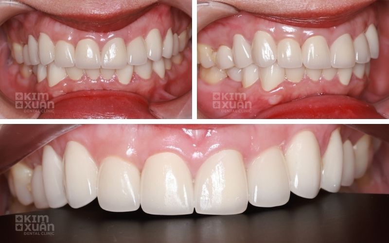 Bọc Răng Sứ Giữ Được Bao Lâu