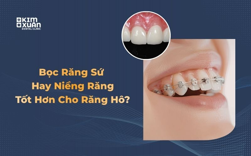 Hình ảnh so sánh bọc răng sứ và niềng răng cho trường hợp răng hô