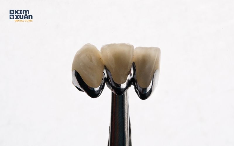 Bọc Răng Sứ Kim Loại Giá Bao Nhiêu