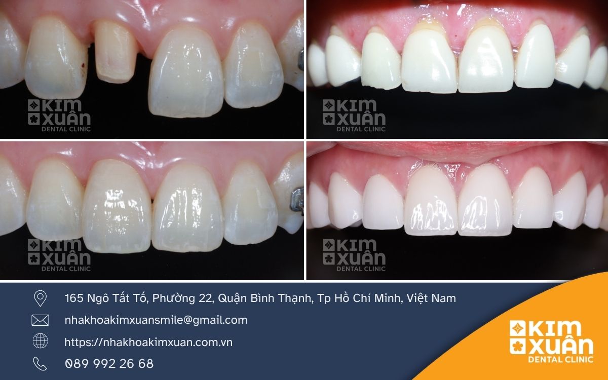 Bọc Răng Sứ Có Đau Không