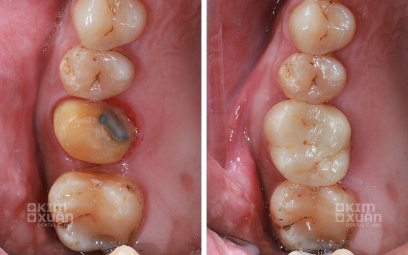 Bọc Răng Sứ Nha Khoa Kim Xuân