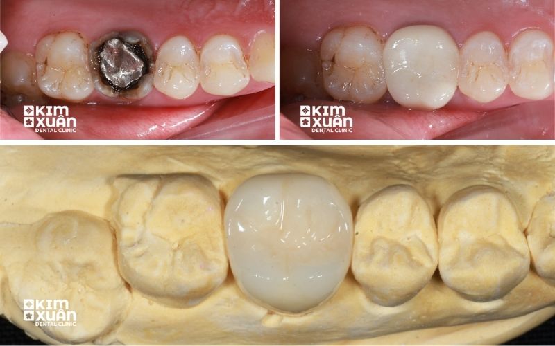 Bọc Răng Sứ Sau Khi Lấy Tủy Răng