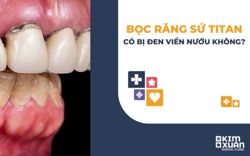 Bọc Răng Sứ Titan Có Bị Đen Viền Nướu Không