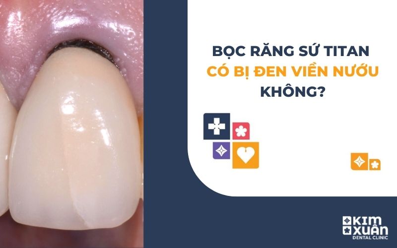 Bọc Răng Sứ Titan Có Bị Đen Viền Nướu Không