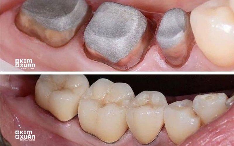 Bọc Răng Sứ Titan Có Tốt Không