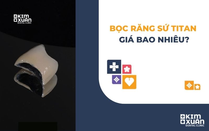 Răng Sứ Titan Giá Bao Nhiêu