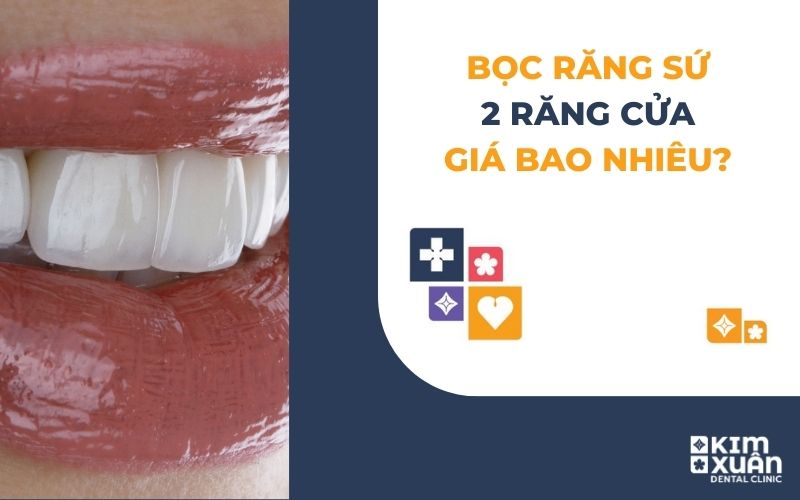 Bọc Sứ 2 Răng Cửa Giá Bao Nhiêu
