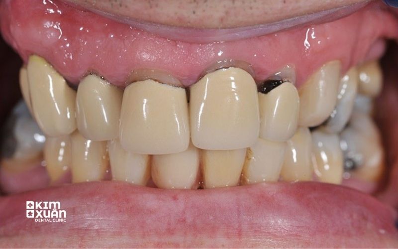 Bọc Sứ Kém Chất Lượng
