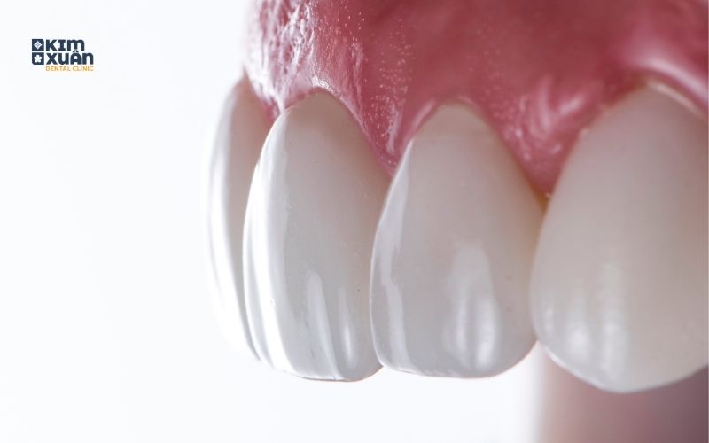 Bọc Sứ Răng Cửa Giá Bao Nhiêu Tiền