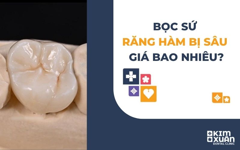 Bọc Sứ Răng Hàm Bị Sâu Giá Bao Nhiêu