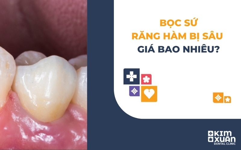Bọc Răng Hàm Bị Sâu Giá Bao Nhiêu Tiền