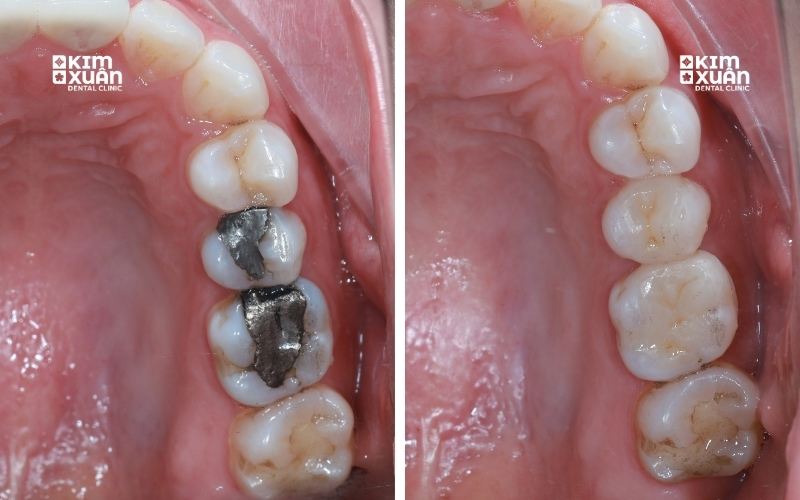 Bọc Sứ Răng Hàm Bị Sâu Tại Nha Khoa Kim Xuân