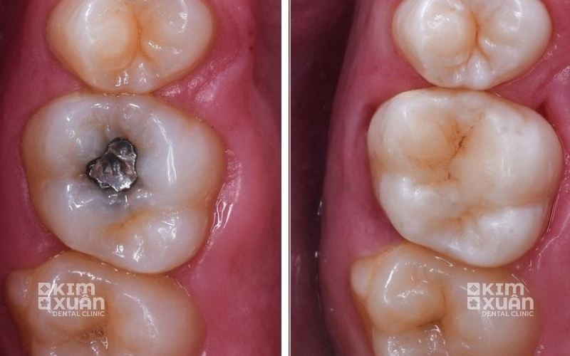 Bọc Sứ Răng Hàm Bị Sâu Có Đau Không