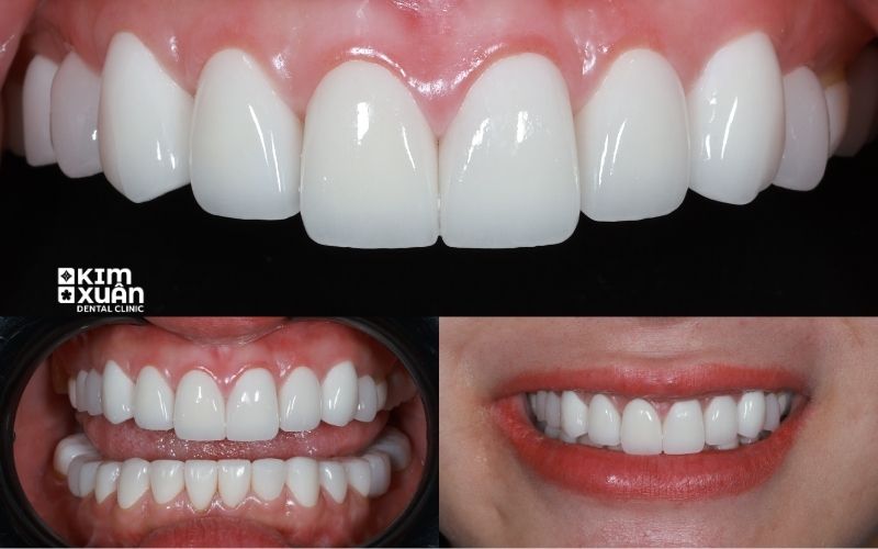 Bọc Sứ Zirconia Giá Bao Nhiêu