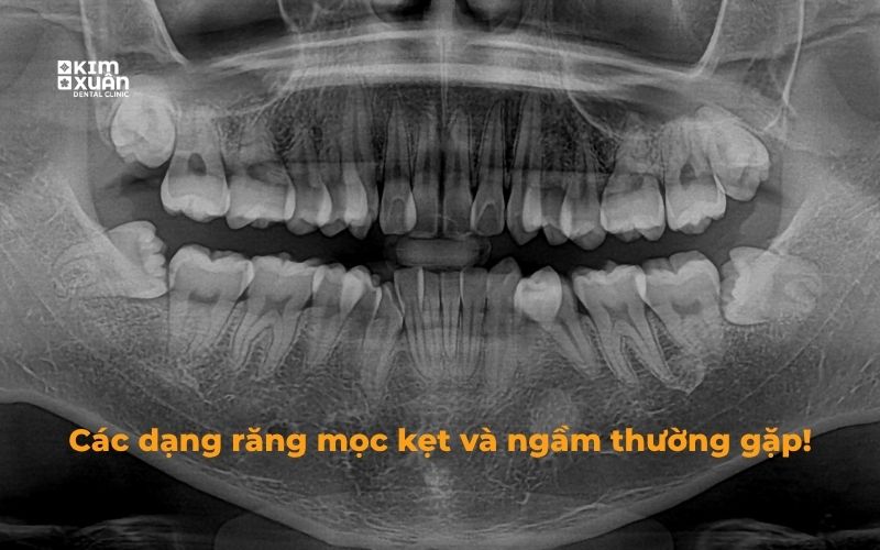 Các dạng răng mọc kẹt, mọc ngầm