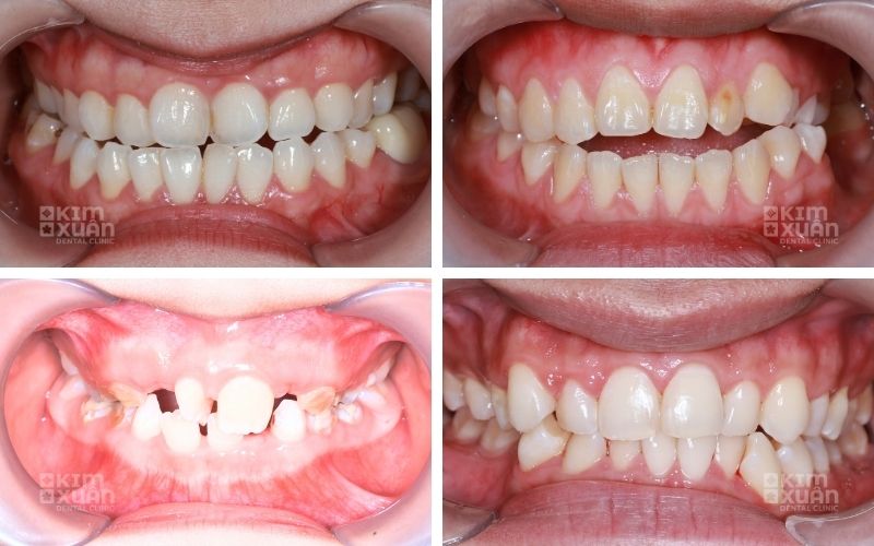 Các Dạng Răng Mọc Lệch Lạc