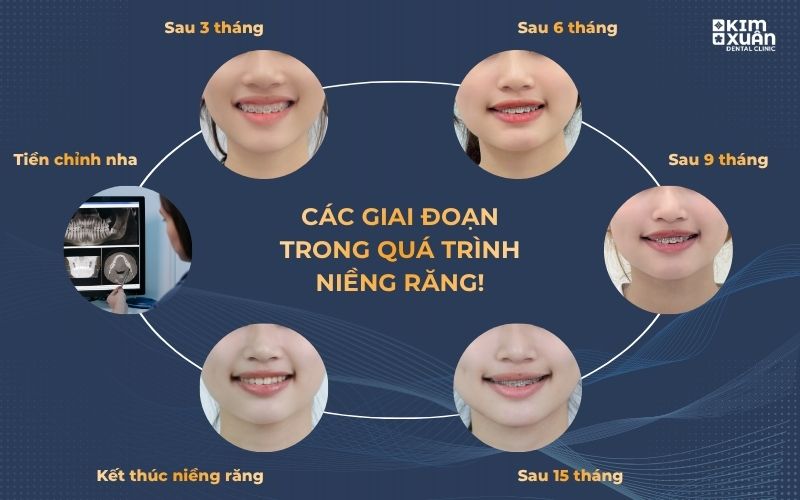 Các Giai Đoạn Niềng Răng