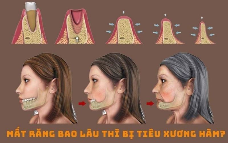 Các Giai Đoạn Tiêu Xương Hàm