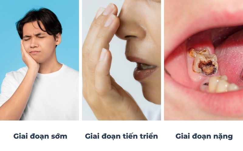 Các Giai Đoạn Nhận Biết Viêm Tủy Răng